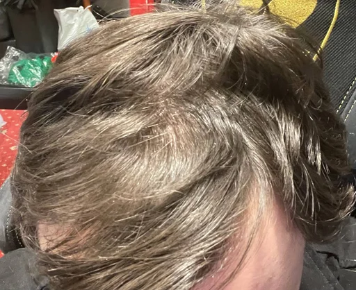 Стикер Самарская алопеция - 5