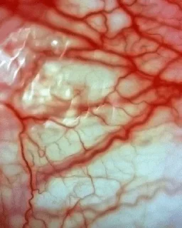 Sticker инсультная грыжа молодого наркозависимого - 6